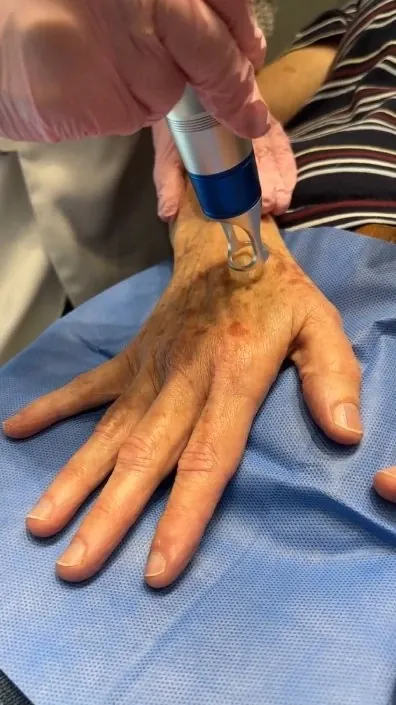 Melasma e manchas